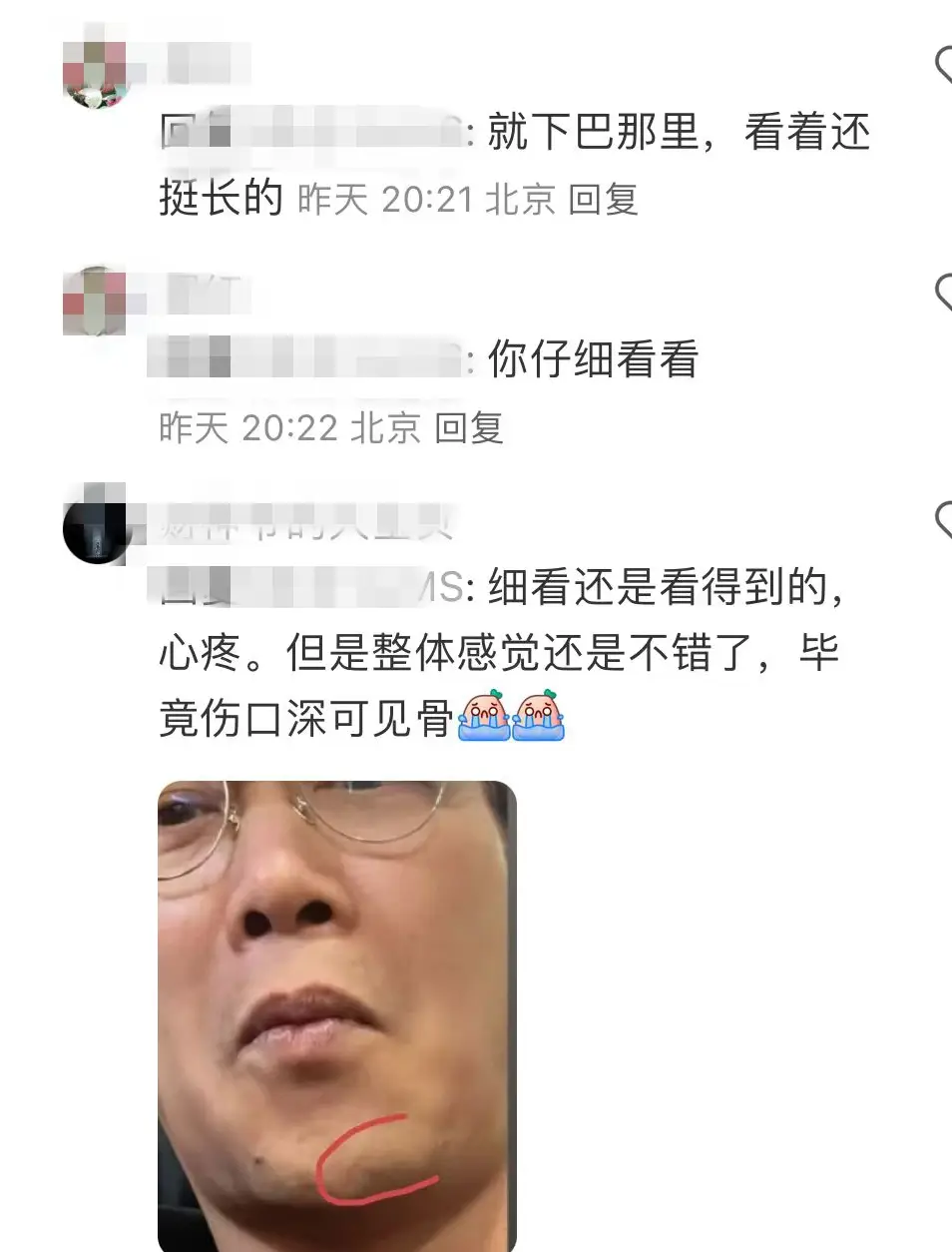 下巴伤疤图片_下巴受伤留下疤痕算伤残吗_